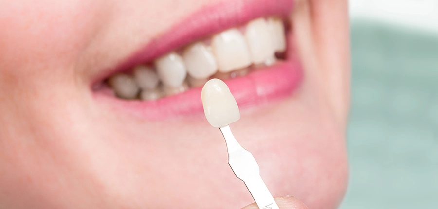 Whitening of individual dark tooth by dentist