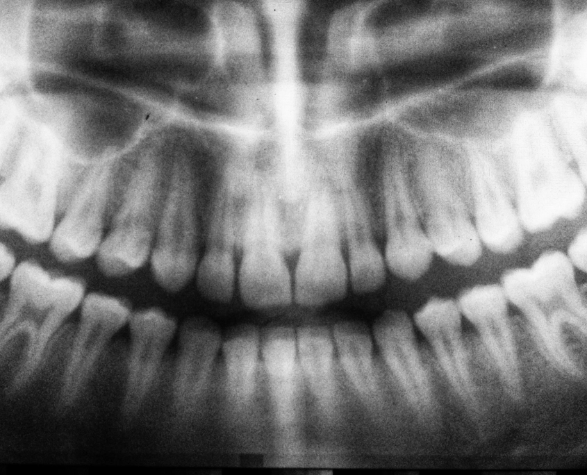 Röntgenbild für Aufklärung und Therapie des Patienten beim Zahnarzt