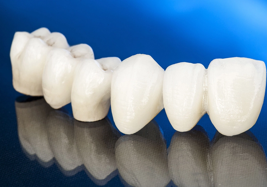 Ceramic veneers, crowns and bridges from the dentist