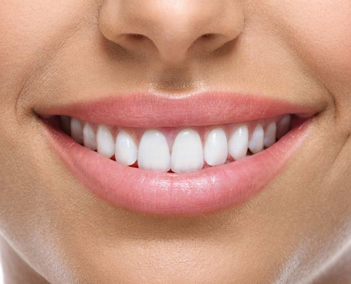 Veneers