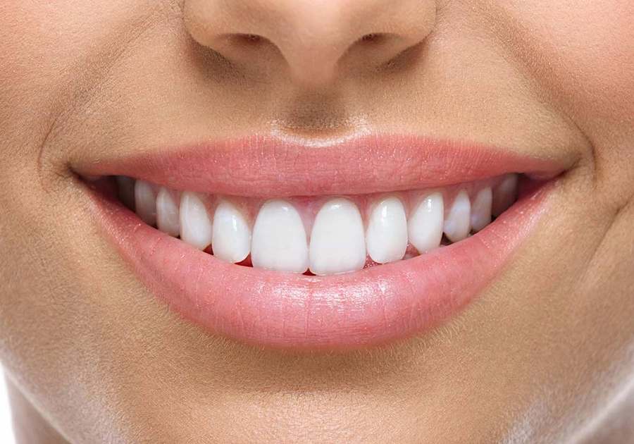 Beautiful teeth thanks to veneers from the dentist