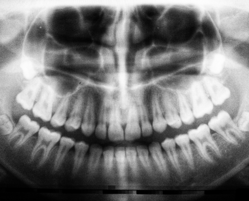 X-ray for advice and therapy of the patient by dentist