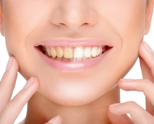 Bleaching/Whitening