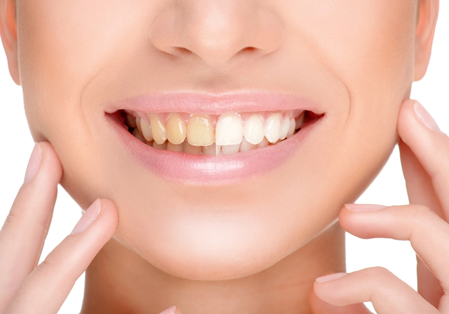 Teeth bleaching/whitening at the dentist for beautiful bright teeth