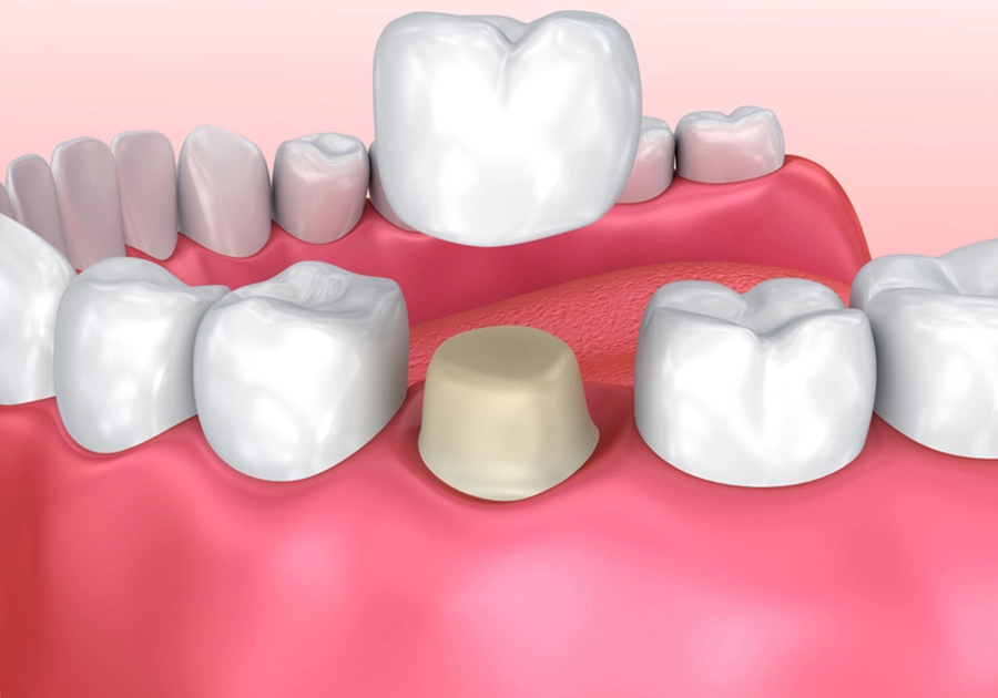 Zahnrestauration nach Wurzelbehandlung mit Zahnkrone vom Zahnarzt