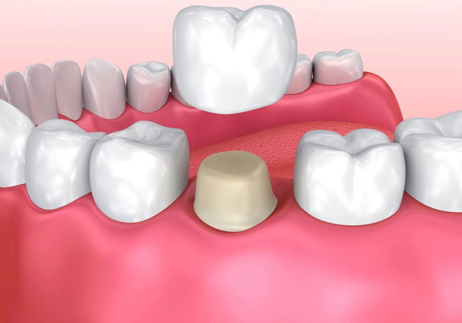 Tooth restoration after root canal treatment with dental crown from the dentist