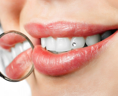 Dental jewellery