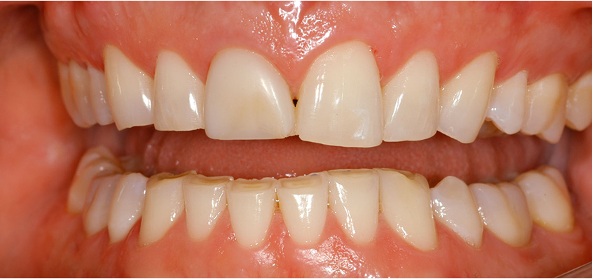 Durch Zähneknirschen (Bruxismus) stark abgenutzte Zähne