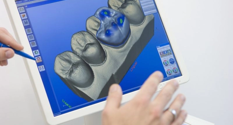Digitale Zahnrekonstruktion mit CEREC 3D bei Zahnärzte Neustadt Passage in Zug