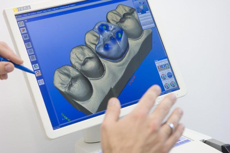 Digital tooth reconstruction with CEREC 3D by the dentists at Zahnärzte Neustadt Passage in Zug