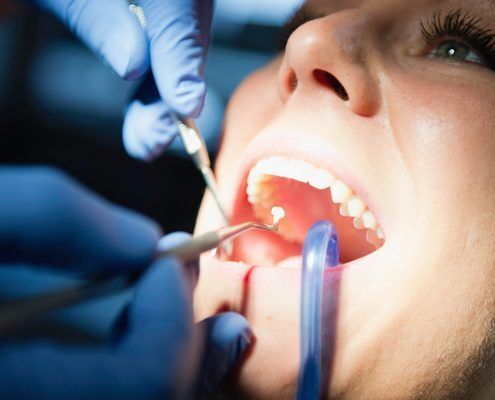 Tooth-colored fillings