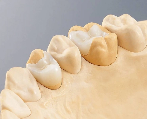 Inlays & Onlays mit CEREC 3D