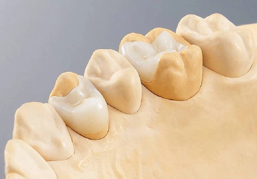 Ceramic inlays and onlays for tooth restoration at the dentist