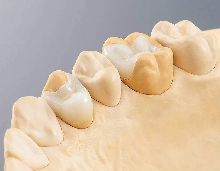 Inlays & Onlays with CEREC 3D