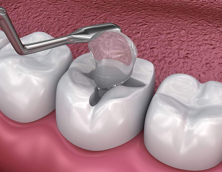 Plastic & Ceramic fillings