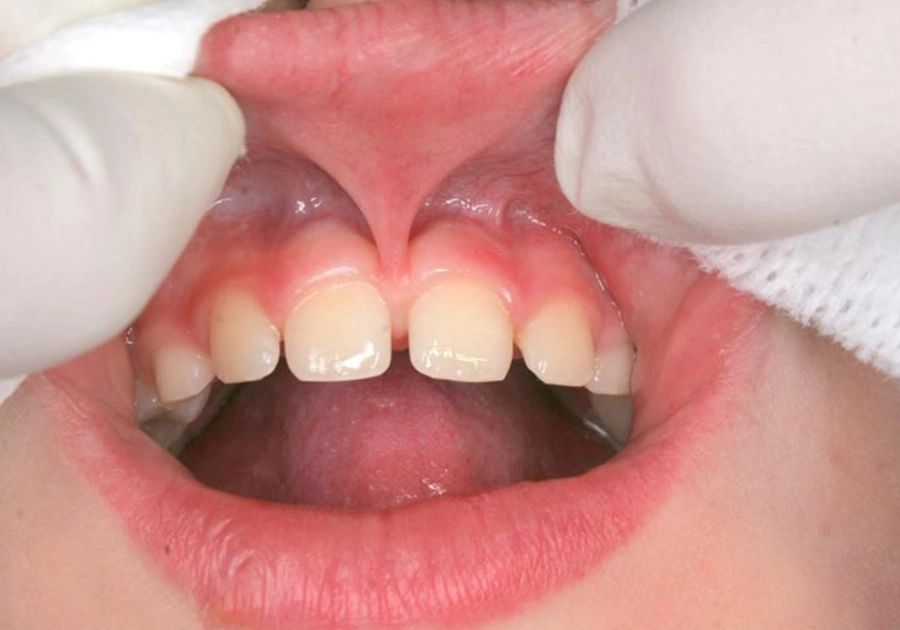 Correction of the labial frenulum at the dentist
