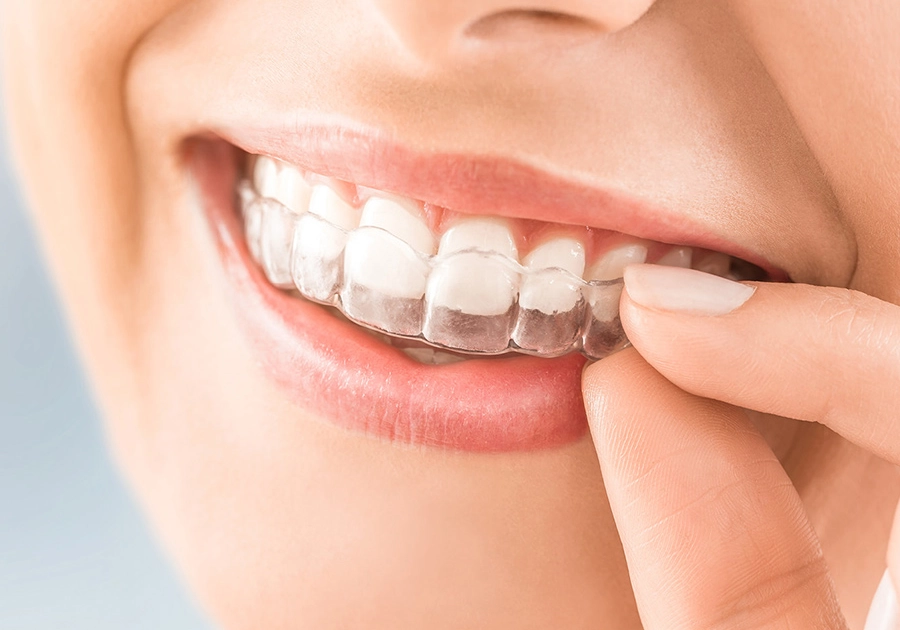 Aligners from the dentist for tooth correction of adults