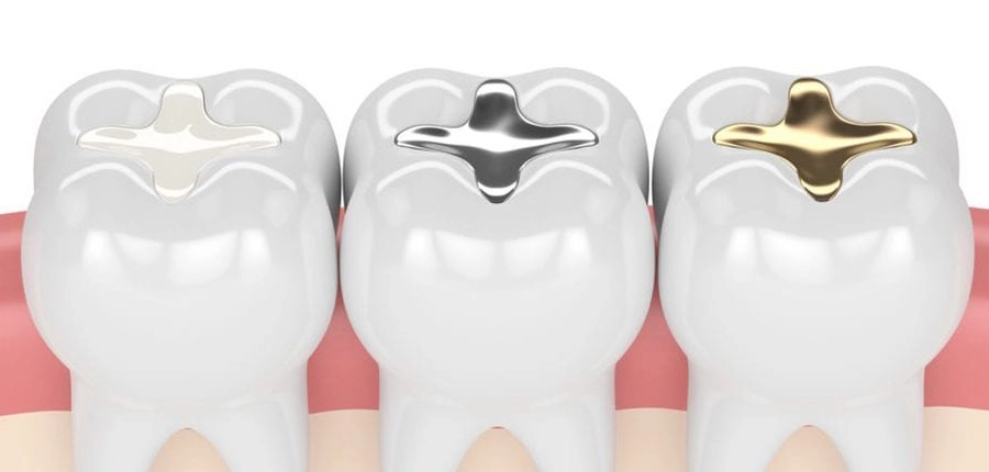 Tooth fillings made of plastics, ceramics and other materials