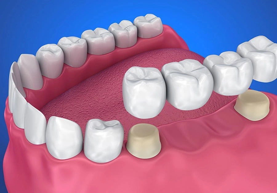 Tooth replacement with dental bridge from the dentist