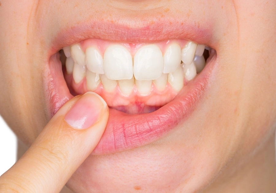 Behandlung von entzündetem Zahnfleisch/Gingivitis beim Zahnarzt