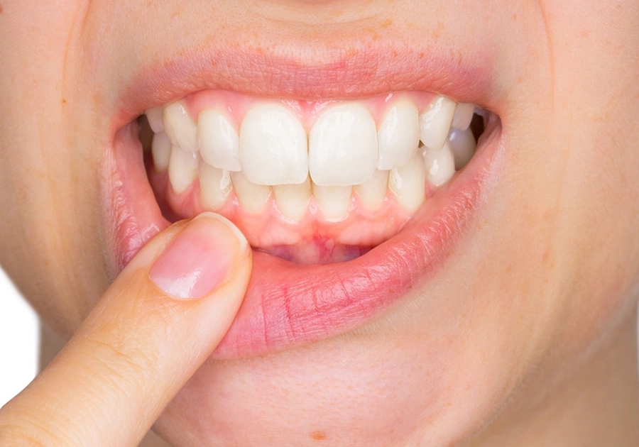 Behandlung von entzündetem Zahnfleisch / Gingivitis beim Zahnarzt