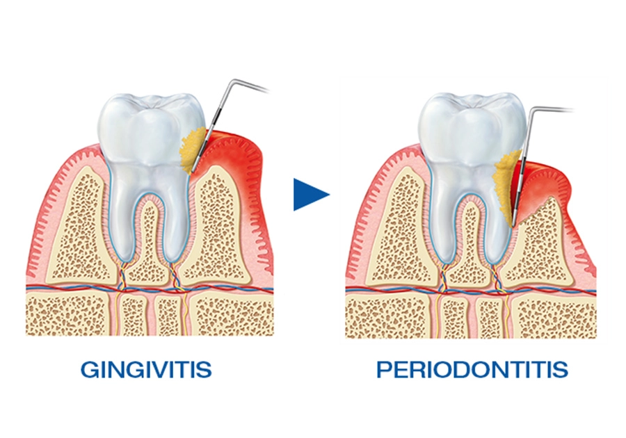 Parodontologie-Behandlung beim Zahnarzt bei Gingivitis und Parodontitis