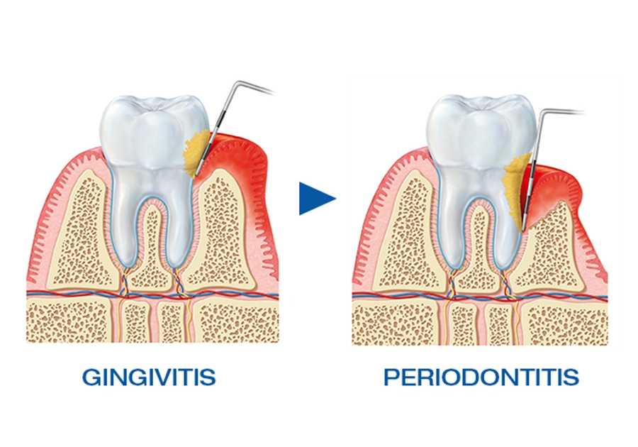 Zahnfleischentzündung behandeln: Illustration für Gingivitis und Parodontitis