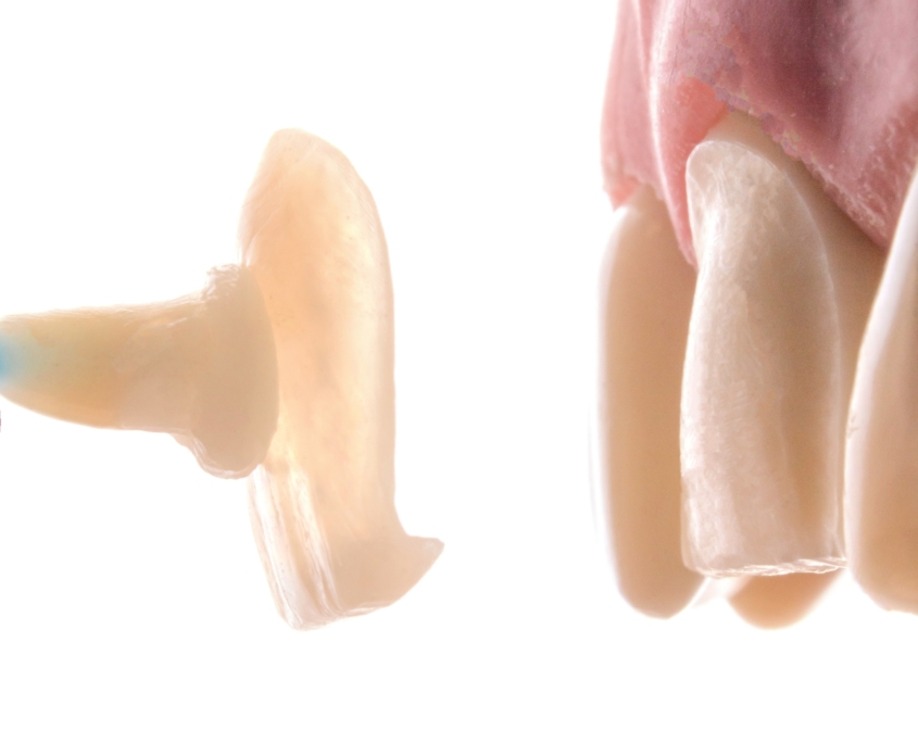 Veneer